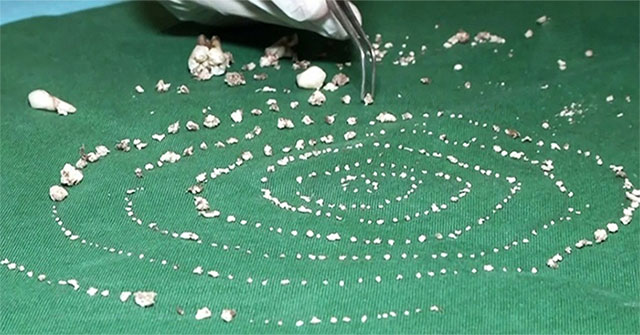 Why do 7-year-olds have 526 teeth?