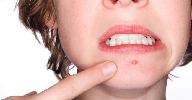 Why do bacteria cause acne only in some people?