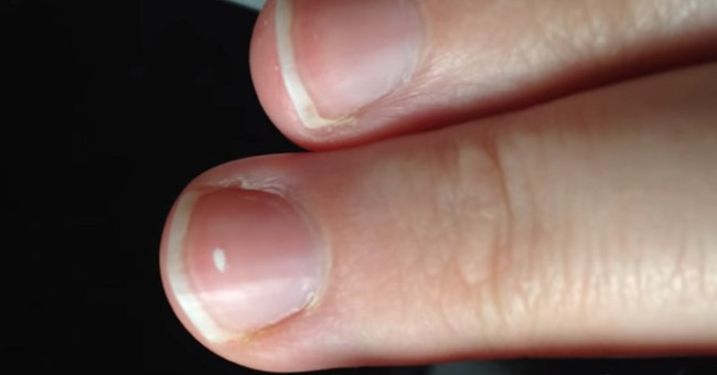 Why do nails have white spots, the reason is simple