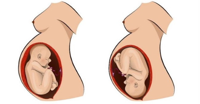 Why does the fetus not turn its head?