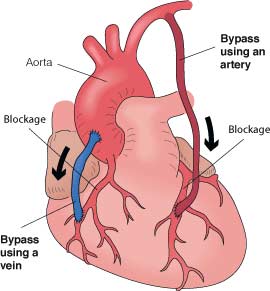 Why does the risk of dying from stroke increase 20 times in the second day?