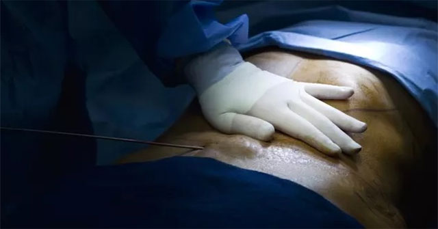 Why fatal liposuction?
