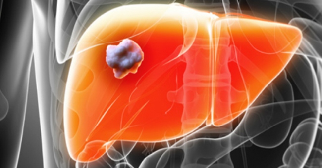 Why is liver cancer today no longer a death sentence?