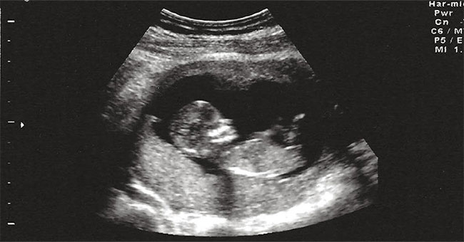 Video The Baby Comes Out Of The Womb