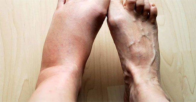 Why is the body swollen when inflamed?