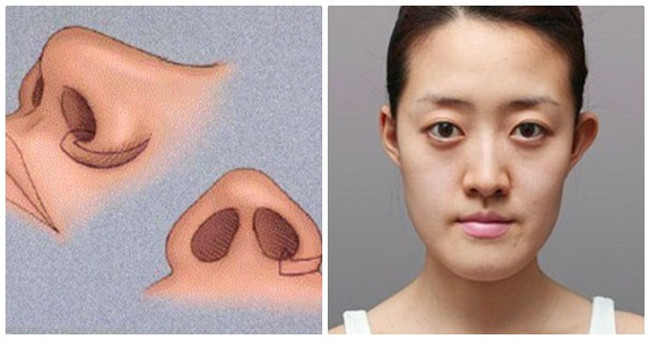 Why is the Vietnamese nose low but the Westerners are high?
