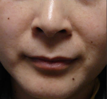Why not count all ... moles?