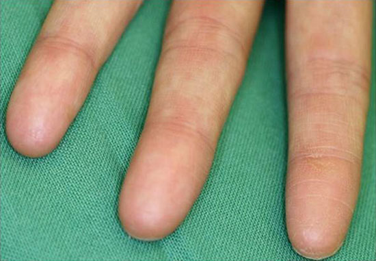 Why people do not have fingerprints?