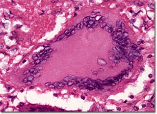 Why treating tuberculosis fail?