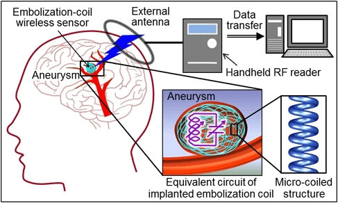 Wireless antenna transplant to monitor cerebral aneurysms