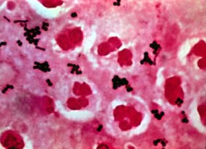 Women are more likely to get skin disease during their menstrual period