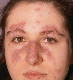 Women with lupus should not become pregnant