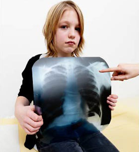 X-rays and leukemia
