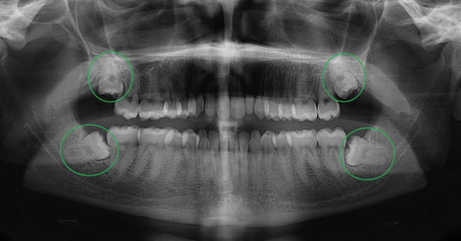 You will not feel pain when you have wisdom teeth if you own this thing in yourself