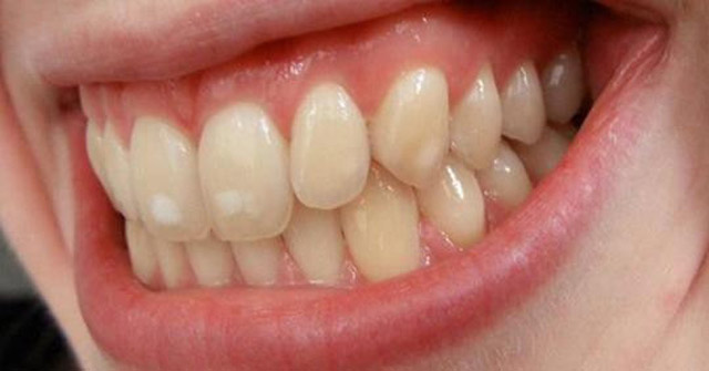 Your teeth have this strange white spot?  This is the reason they appear