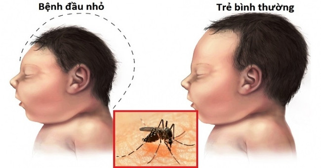 Zika virus spreads 16 districts in Saigon
