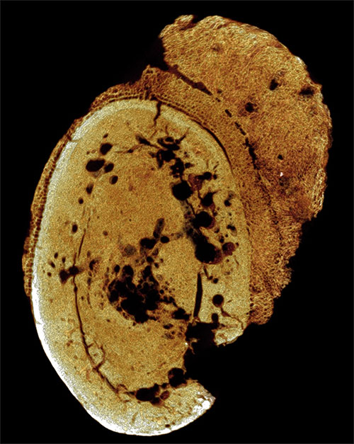 Picture 1 of Unexpected discovery of cancer since ancient times