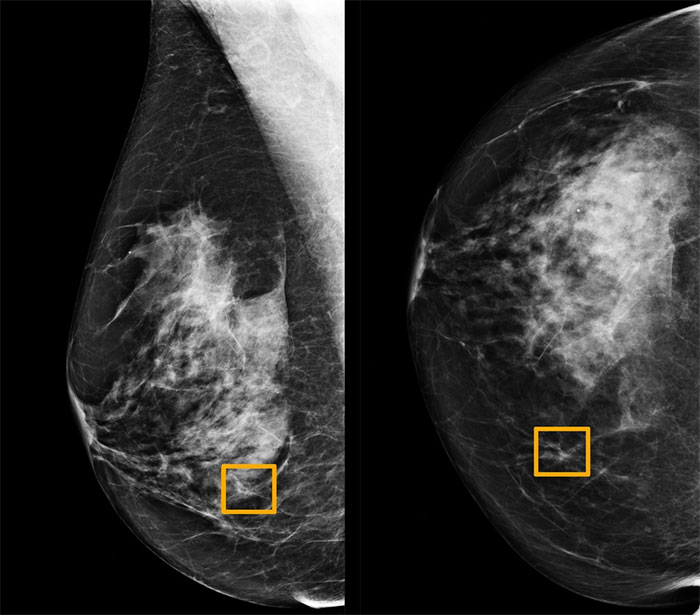 Picture 2 of Unexpected discovery of cancer since ancient times