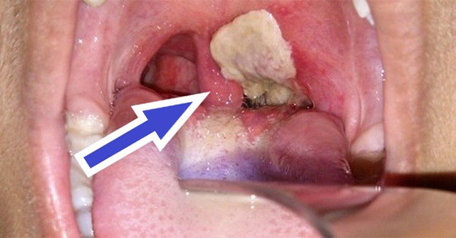 How to distinguish diphtheria and sore throat