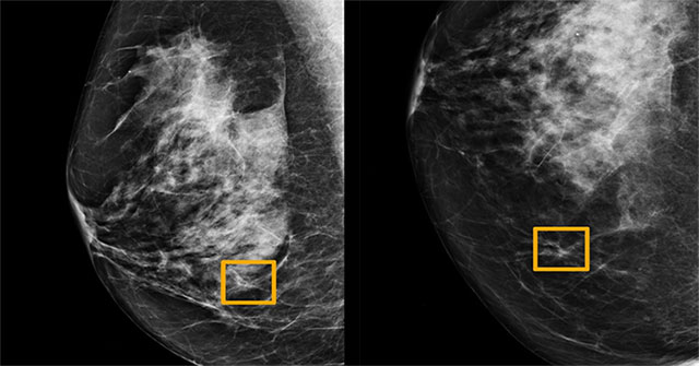 Unexpected discovery of cancer since ancient times
