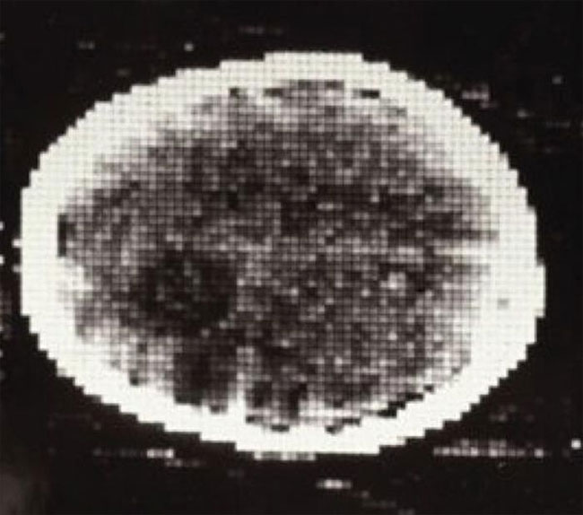 Picture 5 of 50 years ago the first CT scanner let doctors see inside the skull