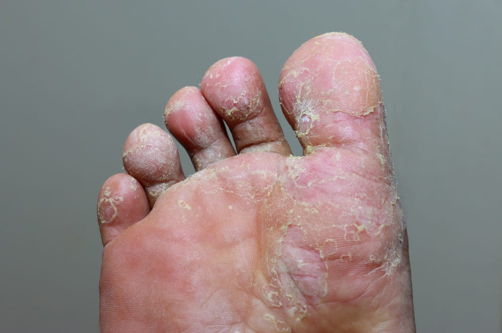 Picture 3 of 8 signs in your feet that warn you of your health