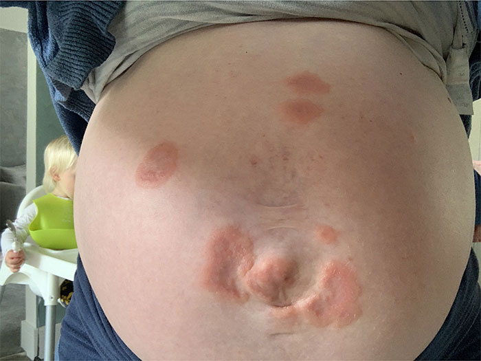 A strange disease causes a mother to have an allergic reaction to her own child Picture 2