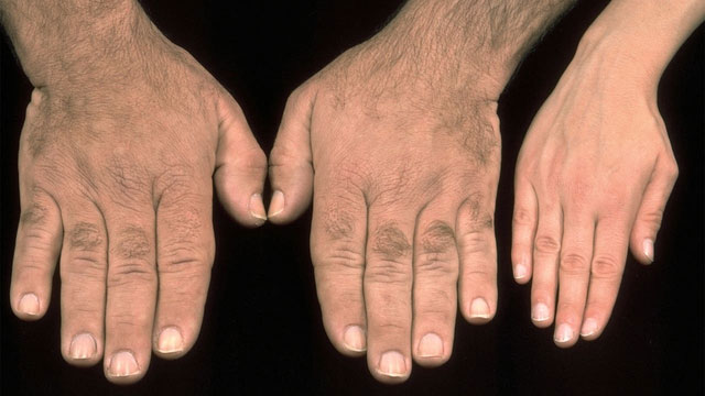 Picture 3 of Acromegaly: A rare disease that causes adults to grow uncontrollably