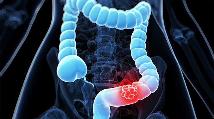 Breakthrough in research on early detection of bowel cancer tumors Picture 1