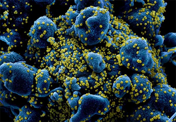 Picture 2 of Cytokine storm - a phenomenon that causes the body to self-destruct before the corona virus