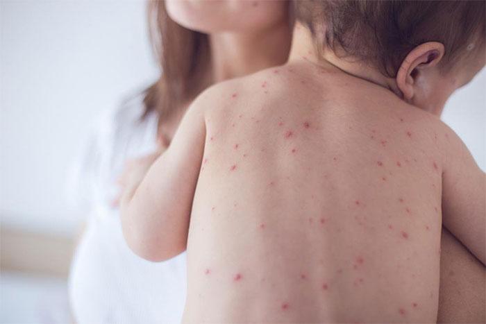 Picture 3 of Dangerous diseases that require vaccination from a young age