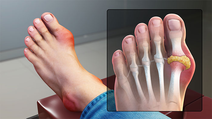 Picture 2 of Distinguish between Gout and Rheumatoid Arthritis