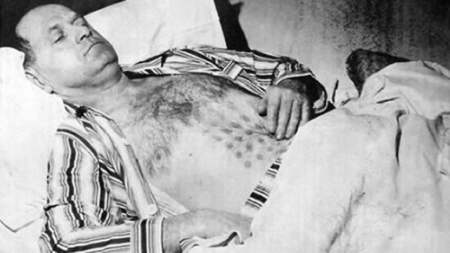 Falcon Lake UFO incident: Man was burned after touching a UFO and the marks on his body did not fade for 32 years! Picture 5