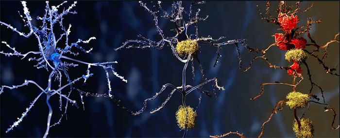 Finding a new potential culprit of Alzheimer's disease Picture 1