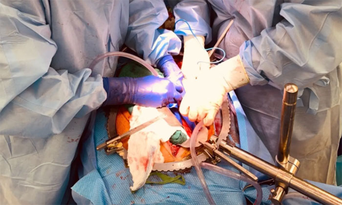 Picture 1 of First successful pig kidney transplant for brain dead people
