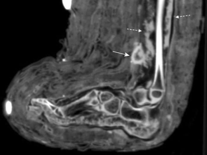 Picture 2 of For the first time, a bandage wound was discovered in an Egyptian mummy