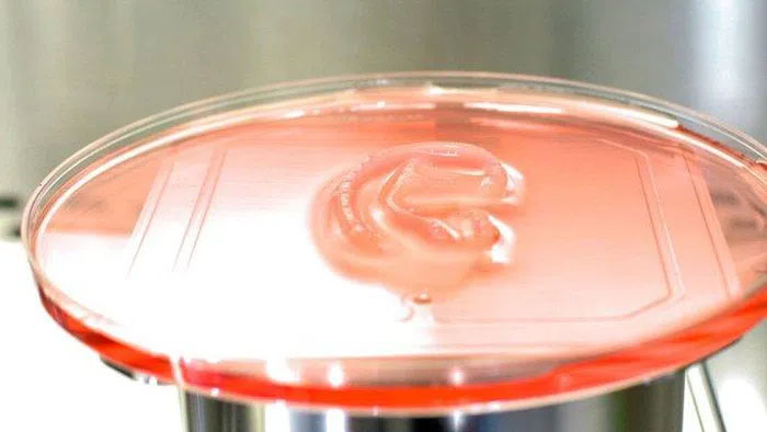 Picture 1 of For the first time in the world: 3D printed human ear, successfully implanted in a girl
