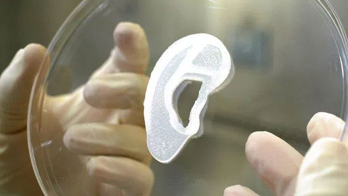 Picture 2 of For the first time in the world: 3D printed human ear, successfully implanted in a girl