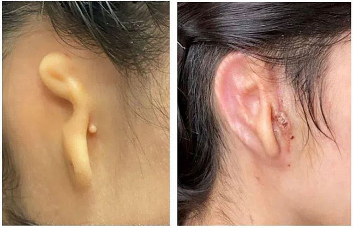 Picture 3 of For the first time in the world: 3D printed human ear, successfully implanted in a girl