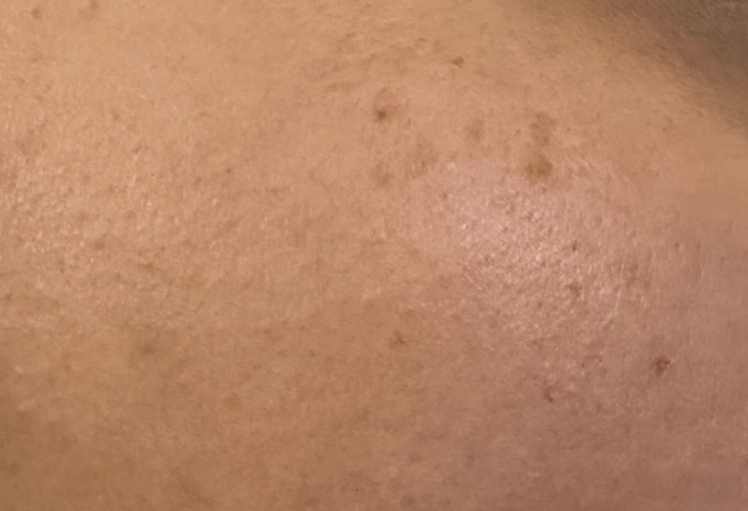 Picture 1 of How are freckles different from melasma?