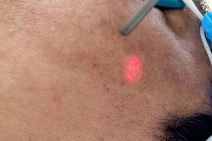 Picture 2 of How are freckles different from melasma?