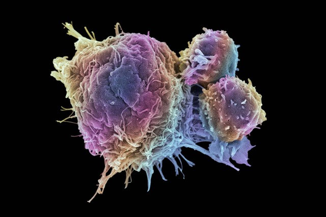 Picture 5 of How do cancer cells exist and grow in our bodies?