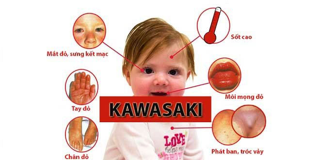 Kawasaki Disease: Causes, Symptoms, and Treatment Picture 1