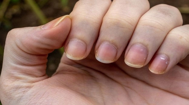 Picture 2 of Little-noticed signs on your nails can warn you about cancer