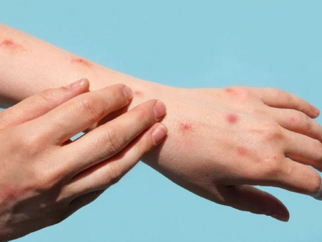 Picture 1 of Medical waste can spread monkeypox virus