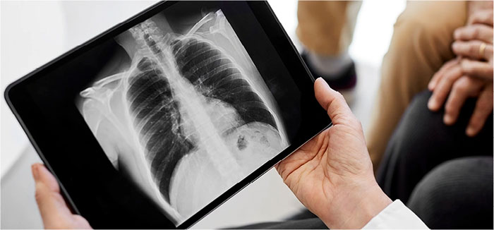 Picture 2 of New discovery on the cause of lung cancer