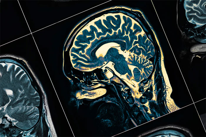 Picture 2 of New research shows: Having mild Covid-19 can also cause changes in brain structure