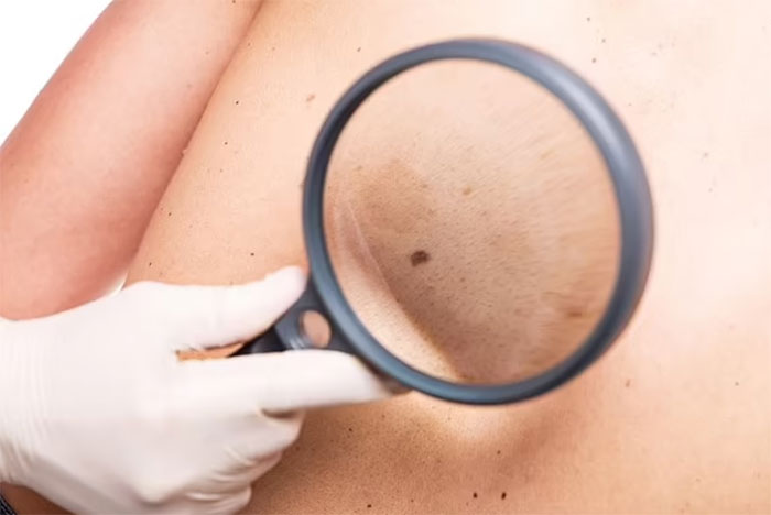 Picture 1 of New technology on 6G phones can help detect skin cancer early