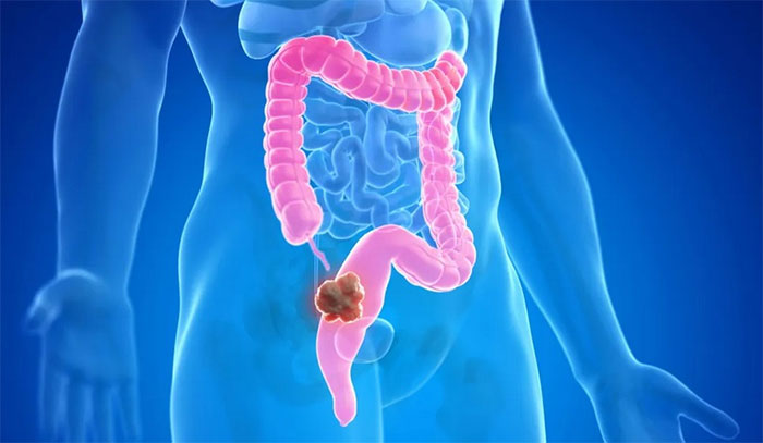 Picture 1 of Positive trial results of drug that 'melts' cancer tumors