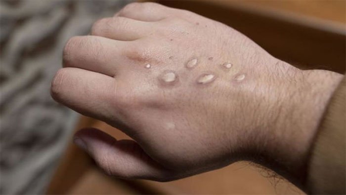 Picture 1 of Singapore confirms first case of monkeypox
